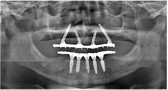 Panorâmica mostra paciente com prótese all-on-4.