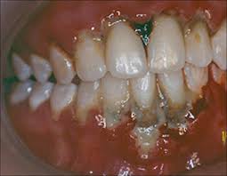 Boca de paciente com periodontite necrosante.