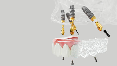 Imagem criada mostrando o planejamento de uma prótese com implantes all-on-4.