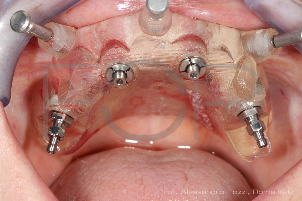 Boca de paciente que já colocou a prótese all-on-4.