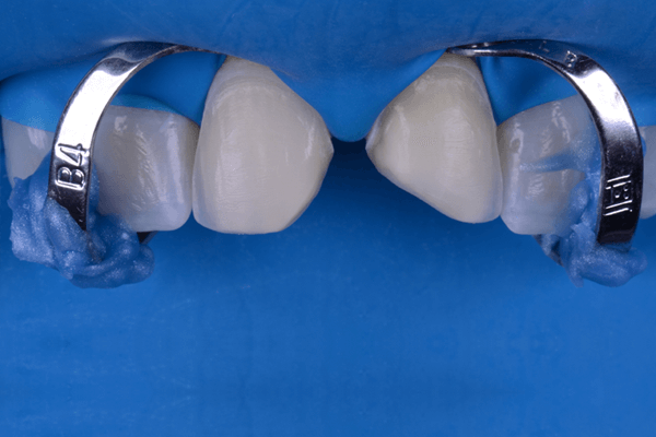 Imagem de boca com isolamento absoluto segurado por grampos odontológicos.