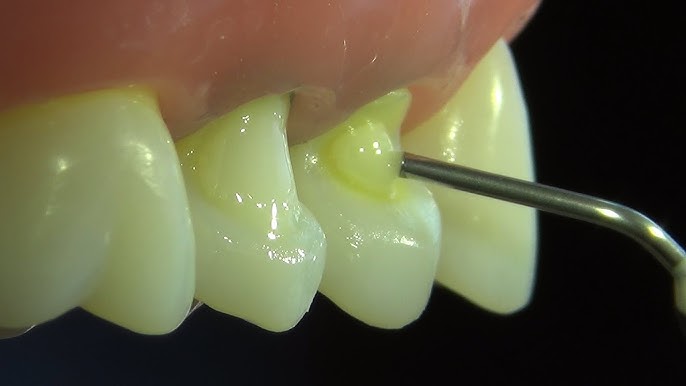 Fazendo restauração em dente com abfração.