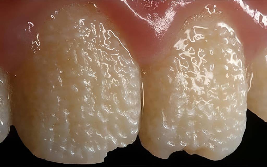 Dentes com esmalte danificado devido a Amelogênese imperfeita.