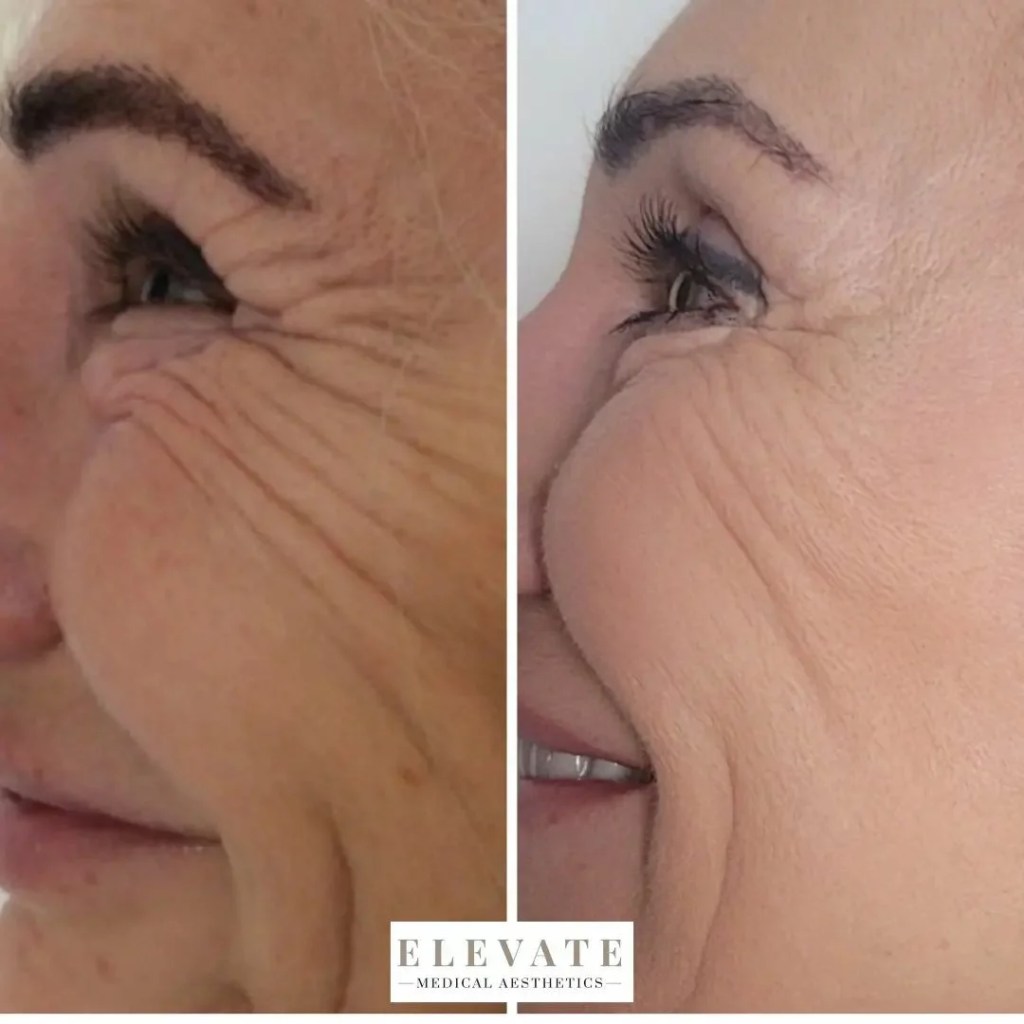 Antes e depois de radiofrequência facial nas linhas do olho em idosa.