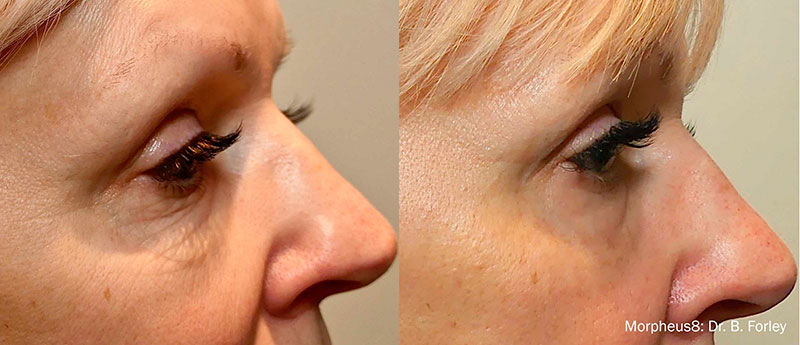 Antes e depois de radiofrequência facial nas olheiras.