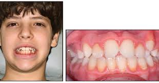 Garoto pré-adolescente com dentes característicos de quem possui deglutição atípica.