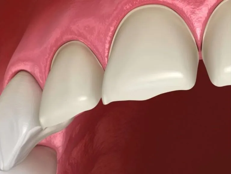 Imagem digital de boca com deglutição atípica.