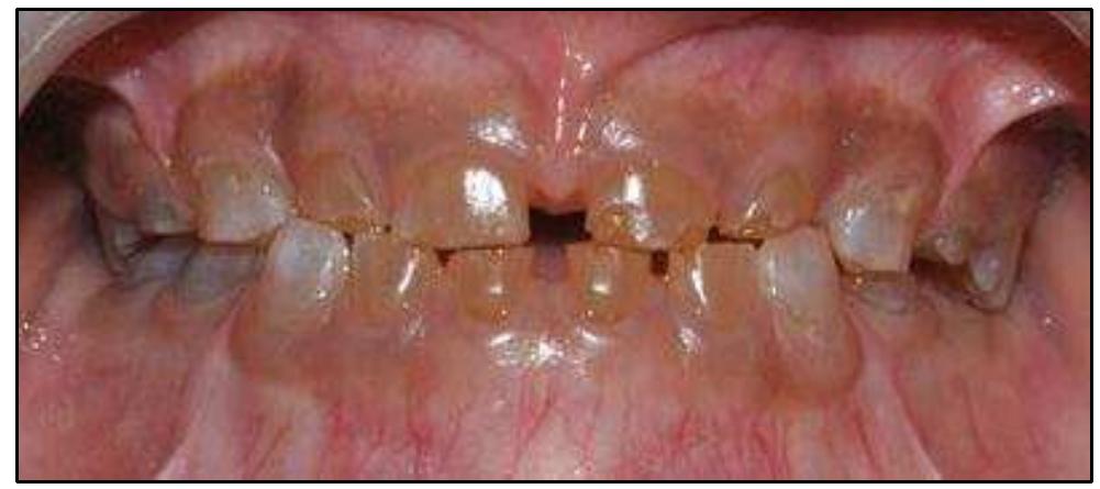 Boca de pessoa com Dentinogênese Imperfeita.