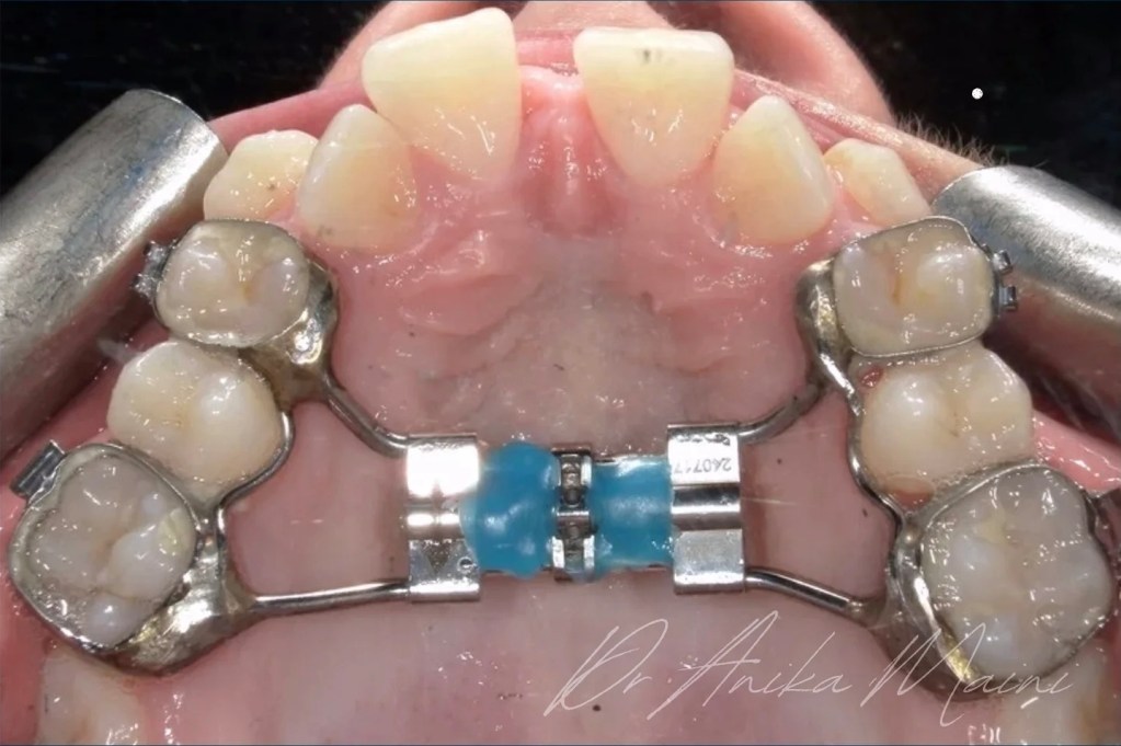 Paciente está usando aparelho de expansão rápida de maxila.