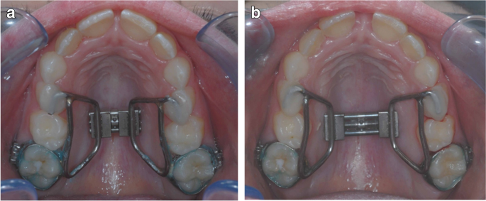 Antes e depois de realizar expansão rápida de maxila.