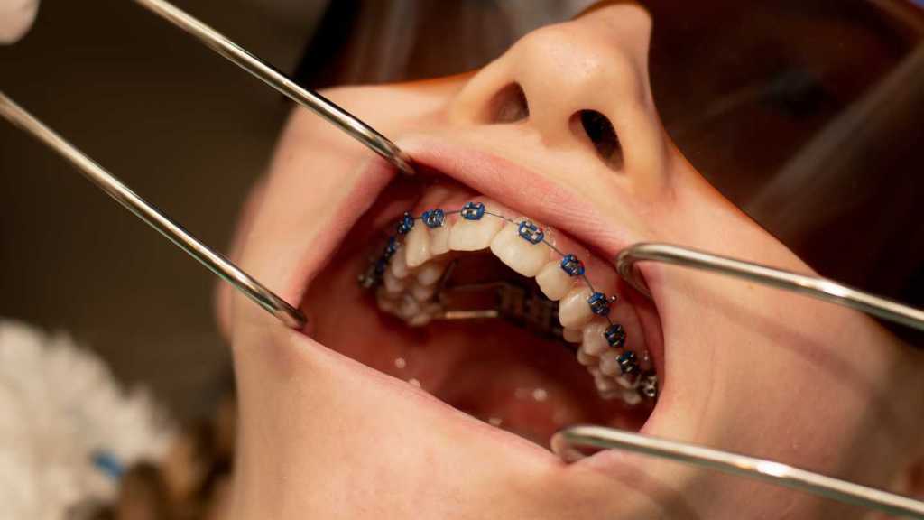 Dentista abriu a boca do paciente que está usando aparelho de expansão rápida de maxila.