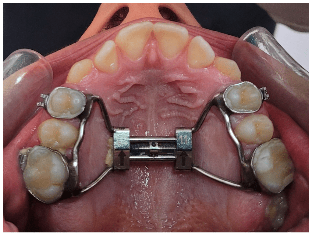 Paciente está usando aparelho de expansão rápida de maxila.