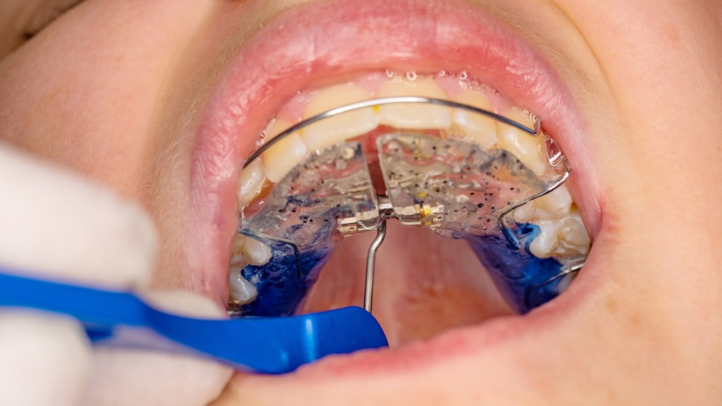 Dentista ajustando expansor rápido de maxila no paciente;