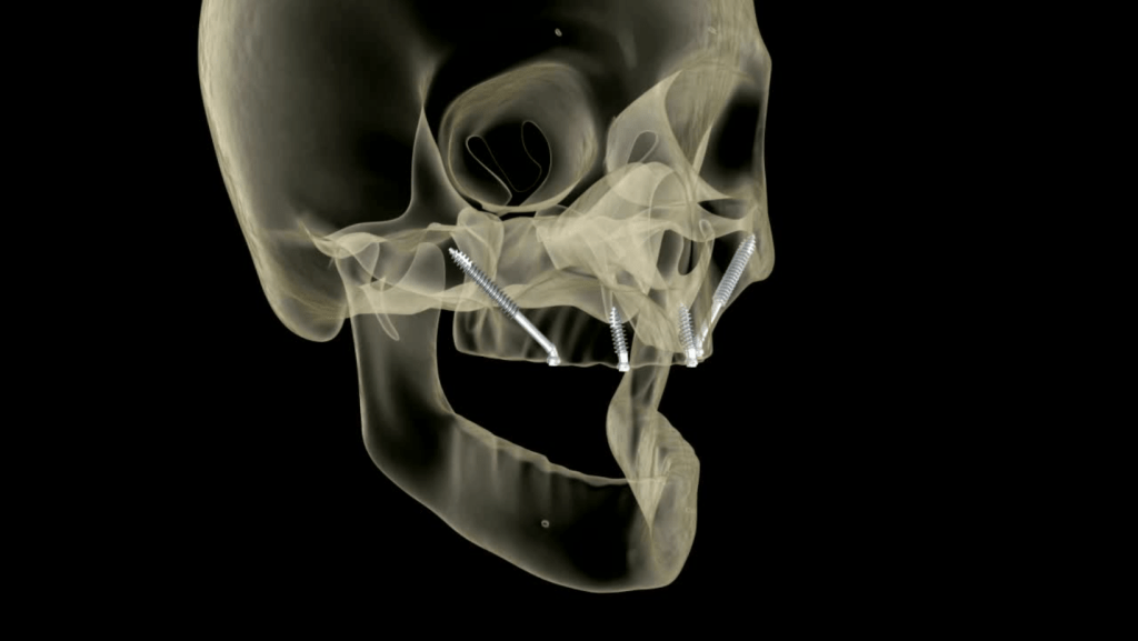 Desenho de crânio para mostrar como ficam os implantes zigomáticos.