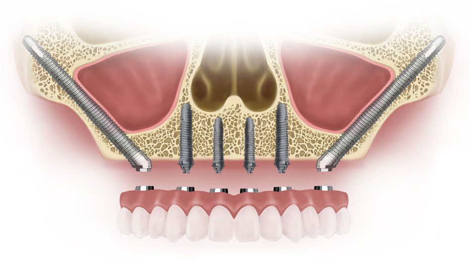Desenho dos ossos da face para mostrar como ficam os implantes zigomáticos encaixados na arcada dentária.