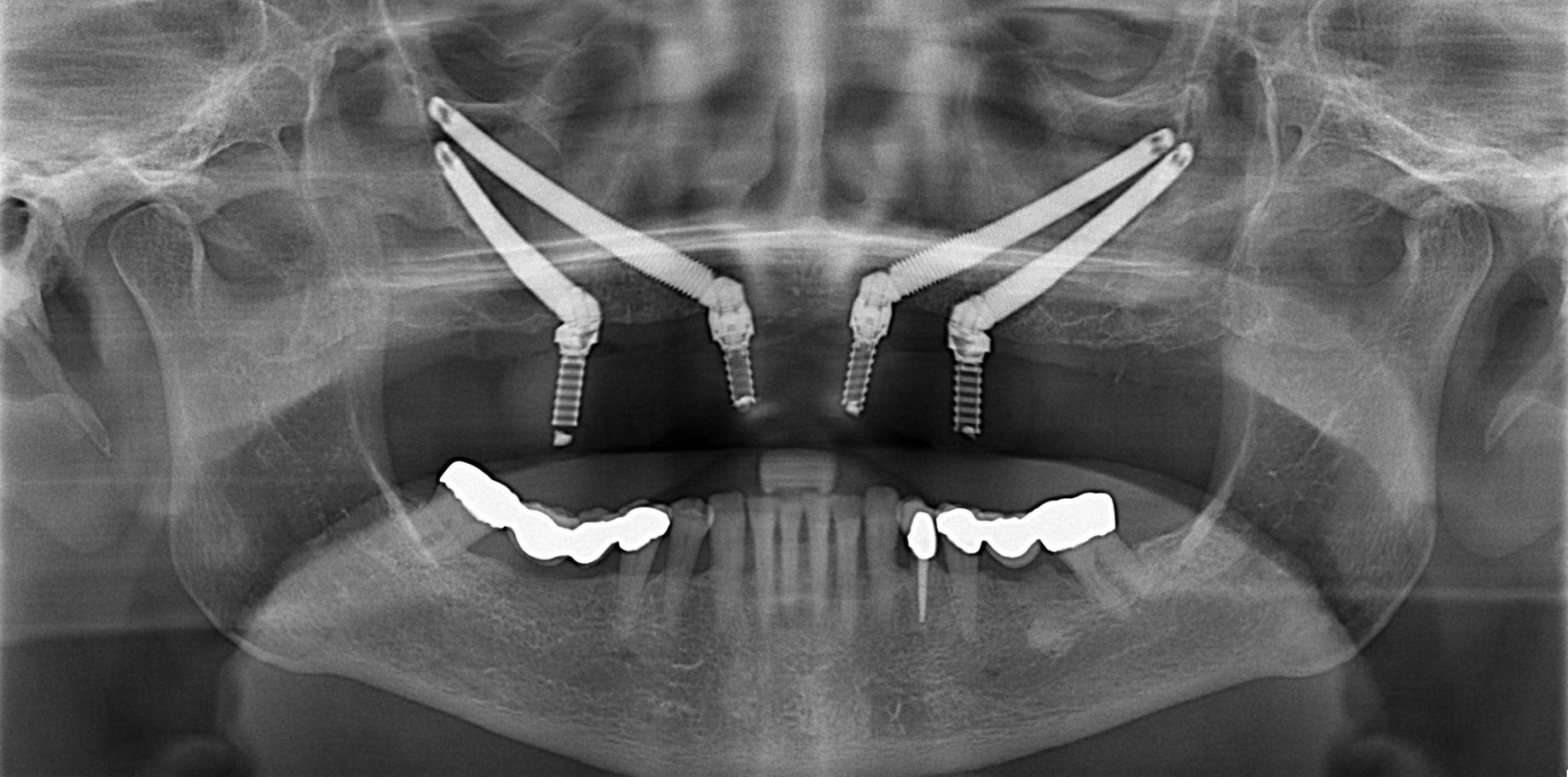 Raio-x panorâmico de paciente que está com implantes zigomáticos.