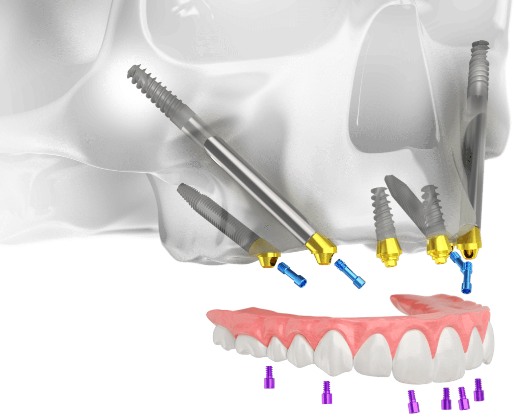 Desenho de crânio para mostrar como ficam os implantes zigomáticos encaixados na arcada dentária.