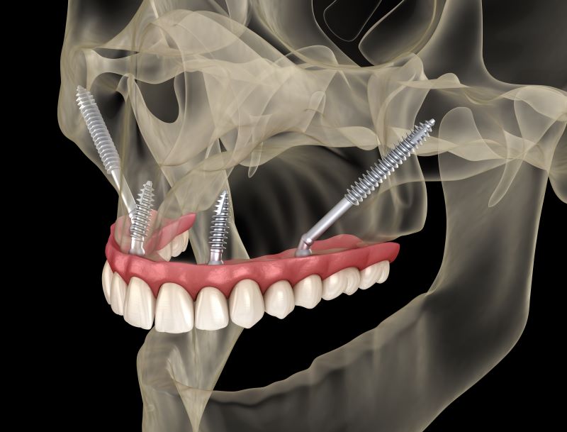 Desenho de crânio para mostrar como ficam os implantes zigomáticos encaixados na arcada dentária.