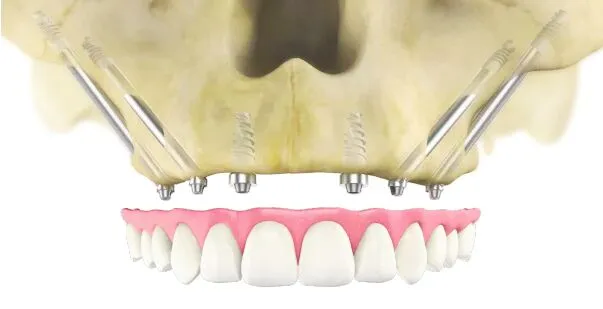 Desenho dos ossos da face para mostrar como ficam os implantes zigomáticos encaixados na arcada dentária.