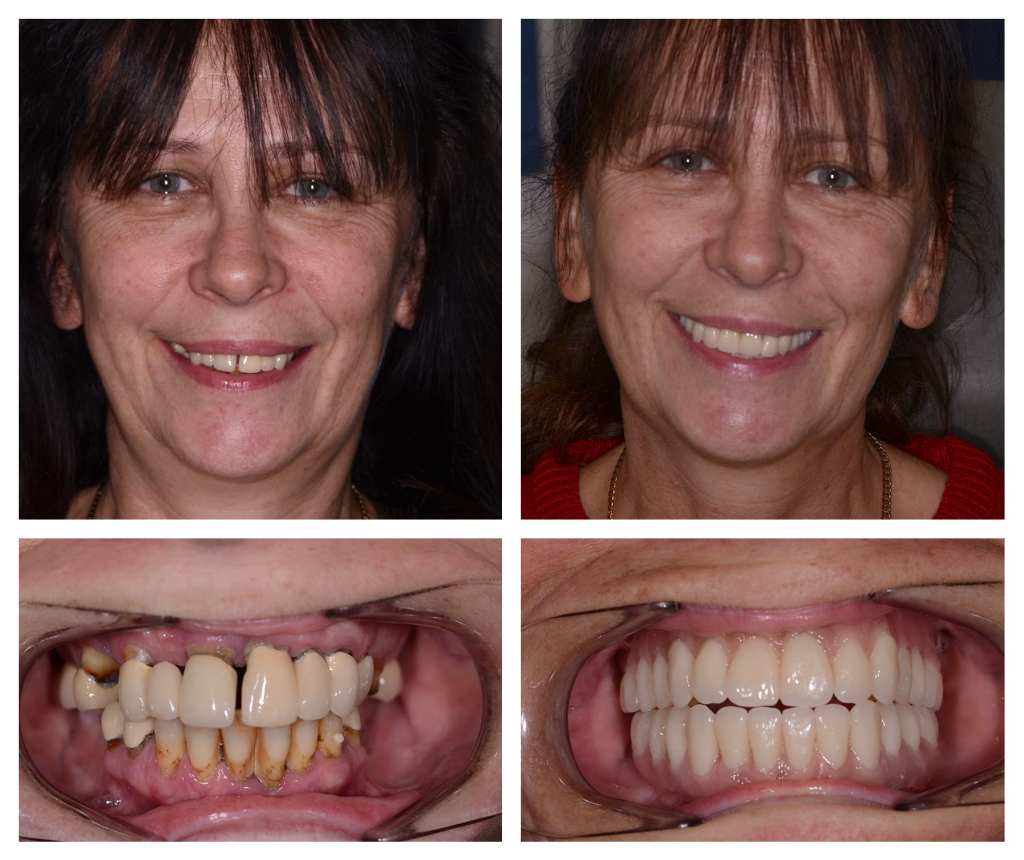 Antes e depois de senhora que colocou implantes zigomáticos, mostrando o rosto dela e de perto só a boca.