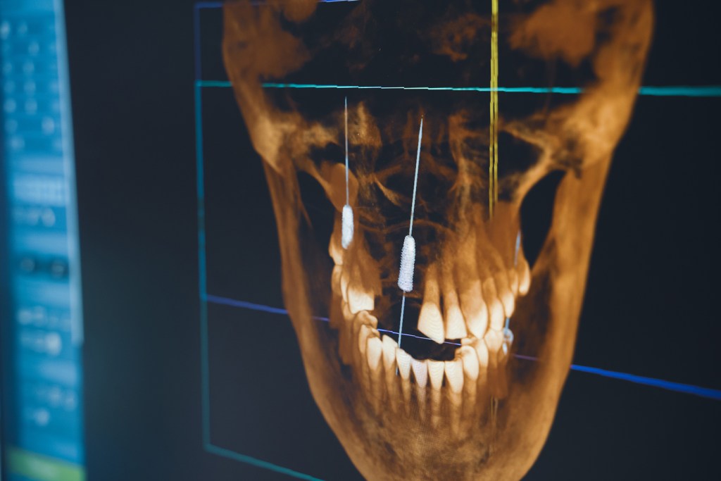 Imagem computadorizada de como vai ser o encaixe dos implantes zigomáticos no paciente.
