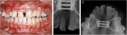 Raios-x de Paciente está usando aparelho de expansão rápida de maxila.