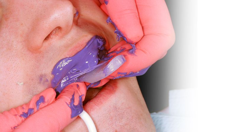 Colocando moldagem com alginato na boca do paciente.