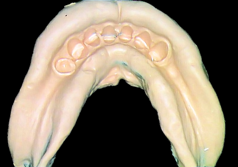 Gesso pronto após desinformar da moldeira.