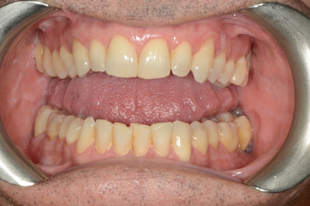 dentes característicos de quem possui deglutição atípica.