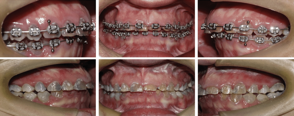Imagens de boca de pessoa com dentinogênese imperfeita com e sem aparelho ortodôntico.