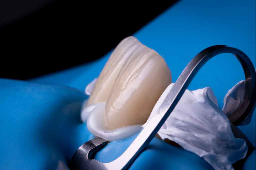 Ponte de dentes "colada" com cimento odontológico.