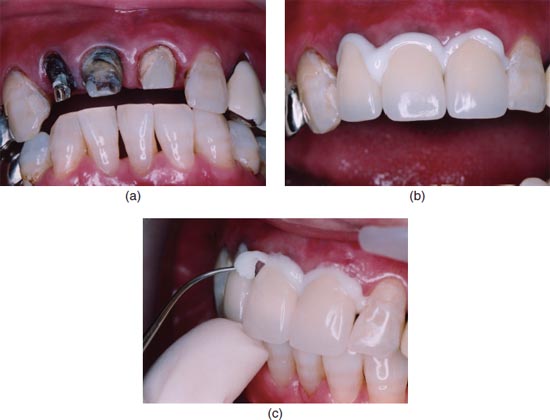Imagem de dente podre, depois consertado e com o cimento odontológico secando, e por último retirando o cimento.
