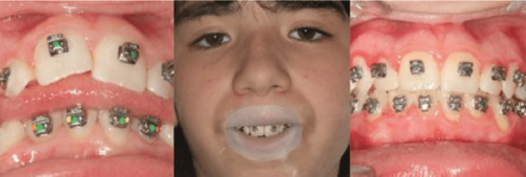 Antes e depois de froggymouth e aparelho ortodôntico que serve para tratar deglutição atípica em garota;