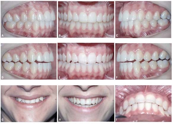 Várias fotos dos dentes do paciente em que foi realizado o desgaste para ajuste oclusal.