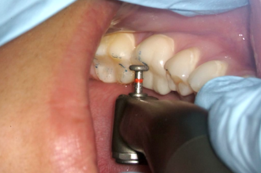 Realizando desgaste dos dentes, um ajuste oclusal.