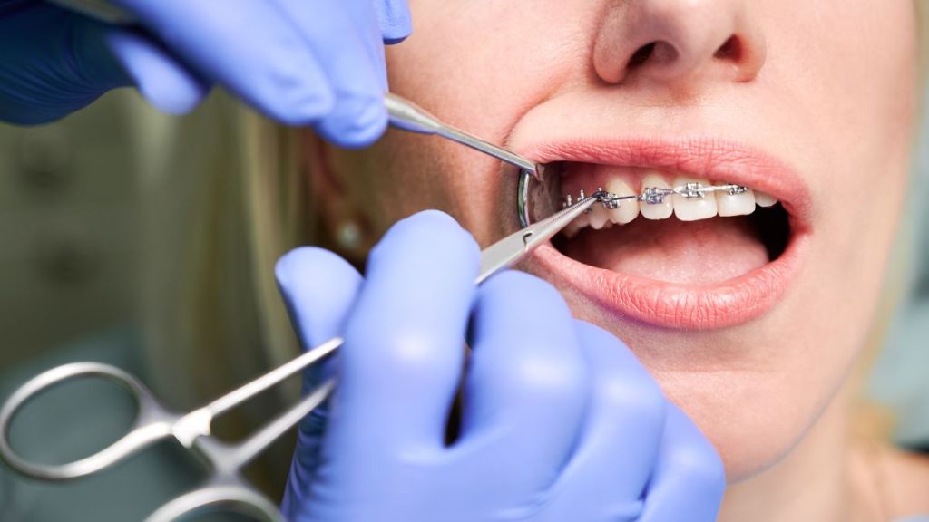 Dentista colocando as borrachinhas do aparelho ortodôntico