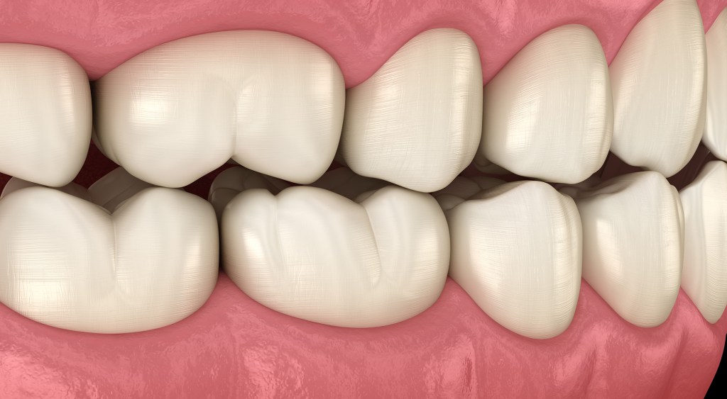 Desenho de dentes com problemas oclusais