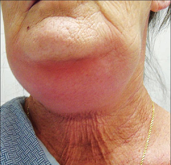 senhora com Angina de Ludwig, embaixo do queixo está muito inchado.