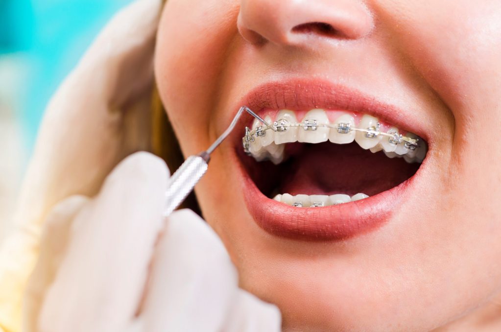 Aparelho Ortodôntico para Adulto em mulher, dentista está arrumando as borrachinhas.