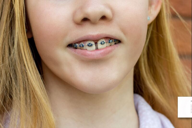 Garota adolescente usa aparelho ortodôntico, e tem diastema.