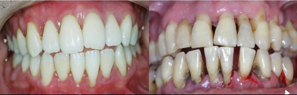 na direita uma boca com doença periodontal extensa, na esquerda é como ficou depois do tratamento