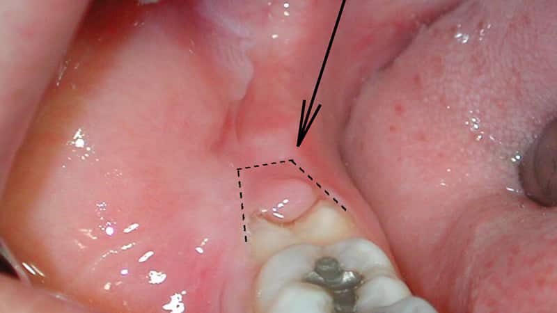Seta aponta para inflamação devido a erupção parcial de siso.