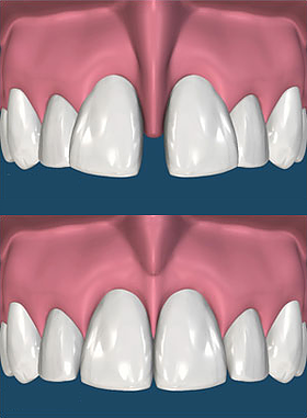 antes e depois da cirurgia de frenectomia que conserta também o diastema.