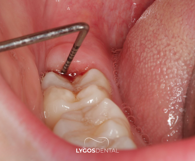 Dentista realizando palpação do opérculo em pericoronarite.