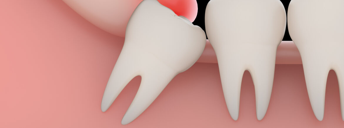 desenho de siso saindo e causando Pericoronarite.