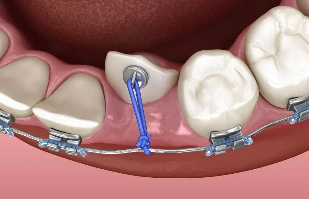 Desenho de como é usada a liguinha em dente que está longe dos demais no aparelho