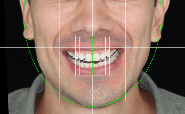 Imagem mostra um homem sorrindo. Então pelo computador foi feito traços para planejar a simetria do sorriso e realizar um recontorno dos dentes.
