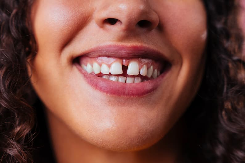 Mulher está rindo, e mostra seu diastema no dente da frente