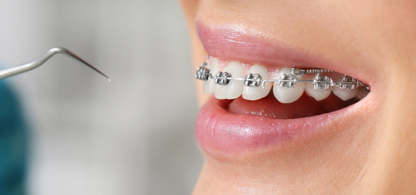 Mulher no dentista usando Aparelho Ortodôntico