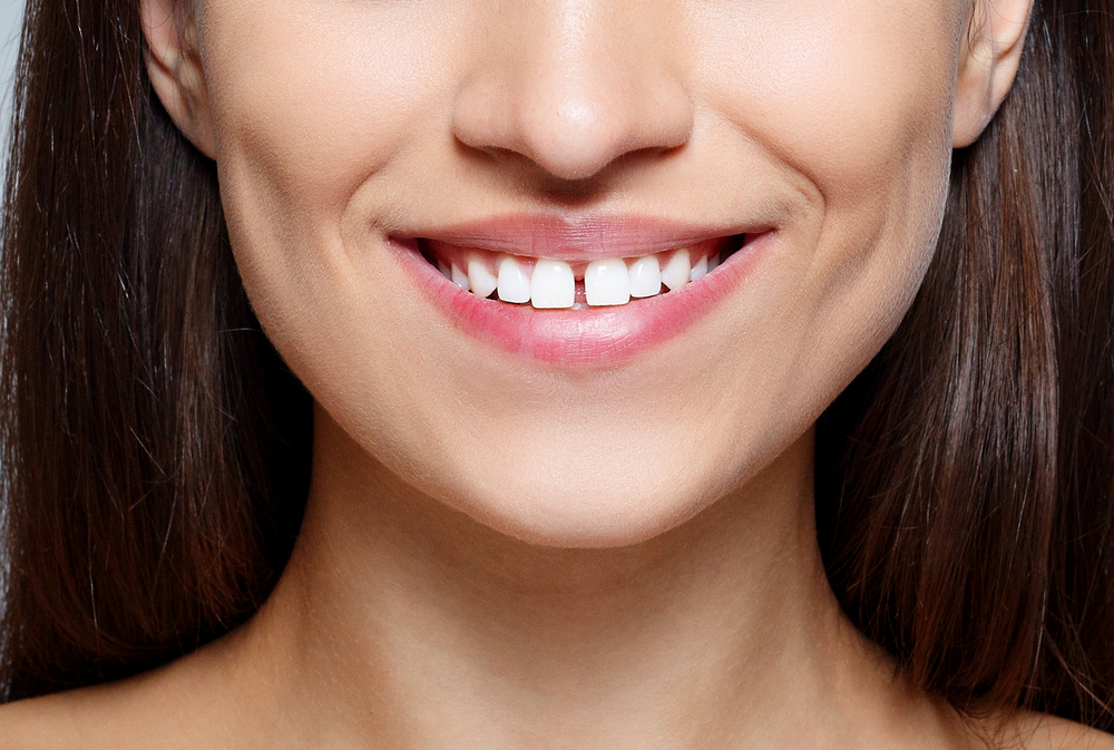Mulher com diastema nos dentes da frente